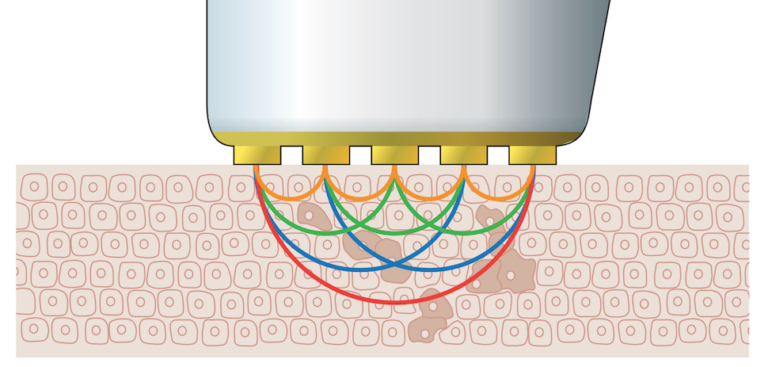 Nevisense melanoma detection device works by sending electrical impulses beneath the skin's survace.