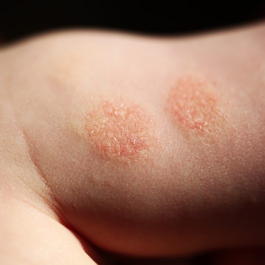 Eczema