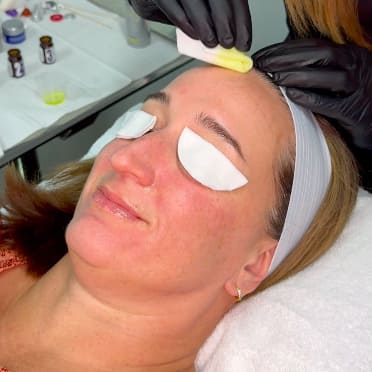 3 Signs you might need a Chemical Peel